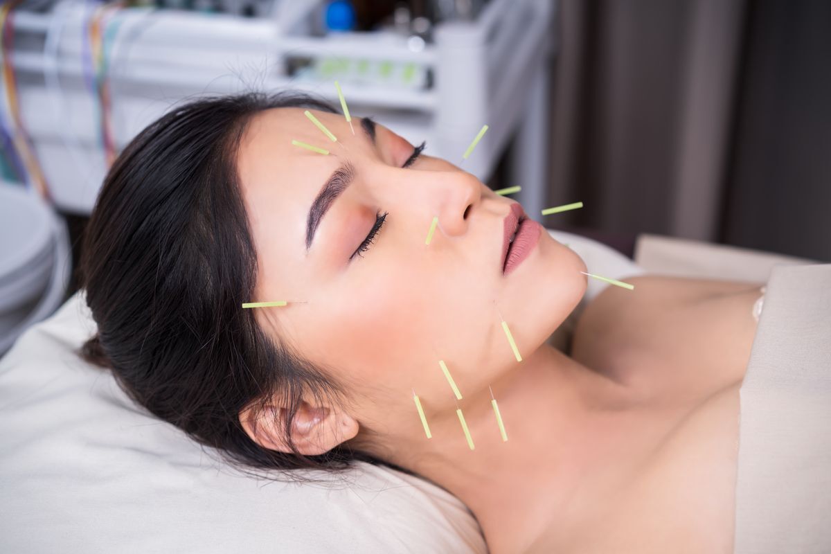 A woman undergoing traditional Chinese medicine acupuncture on face.