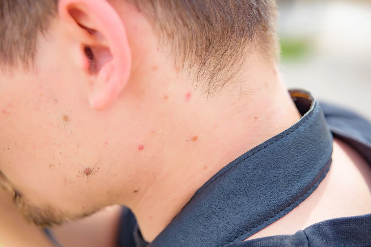 Neck pimples on a man.  