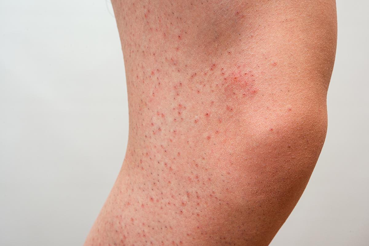 Legs with strawberry skin