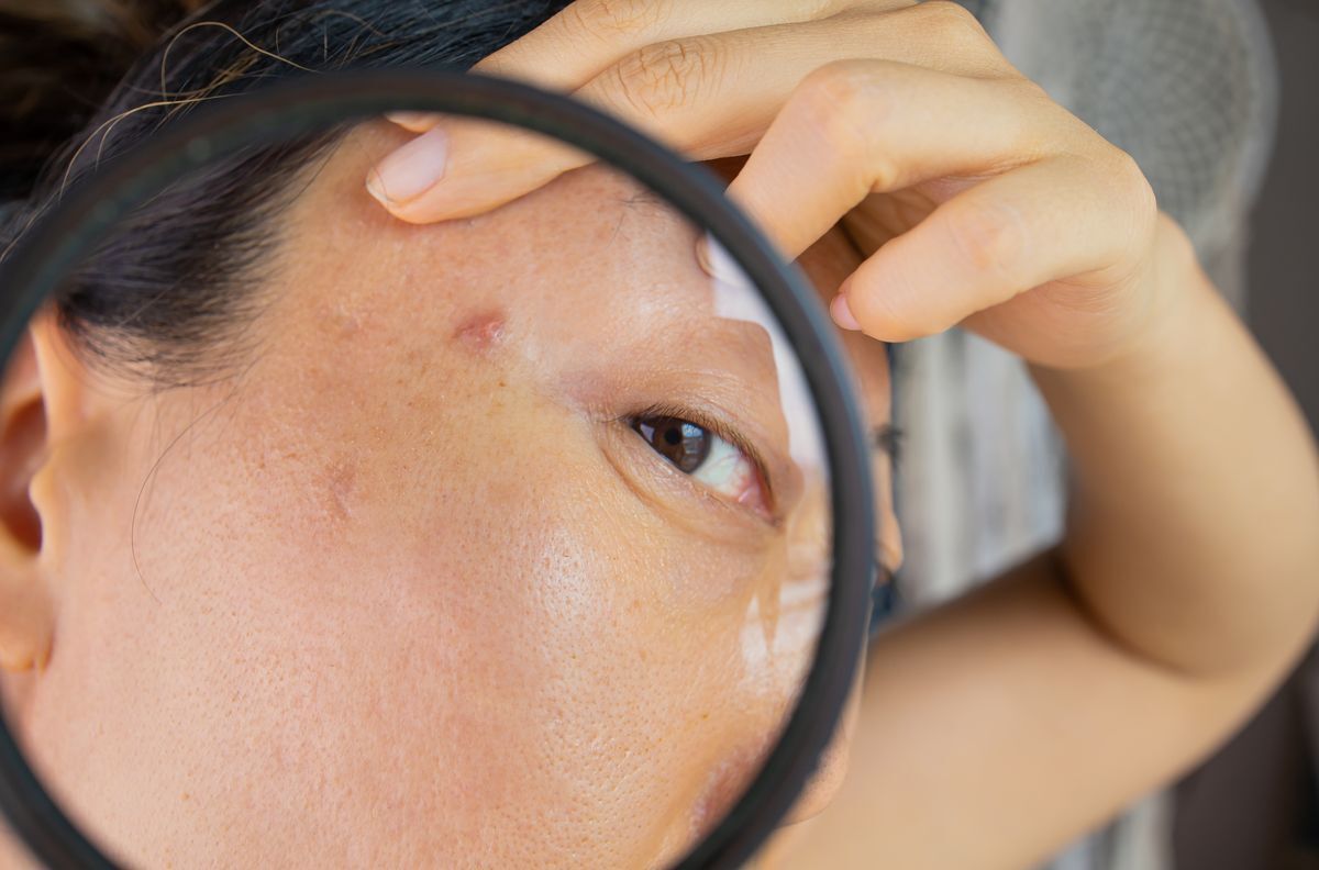 Young Asian woman showing a close up of a pimple. 