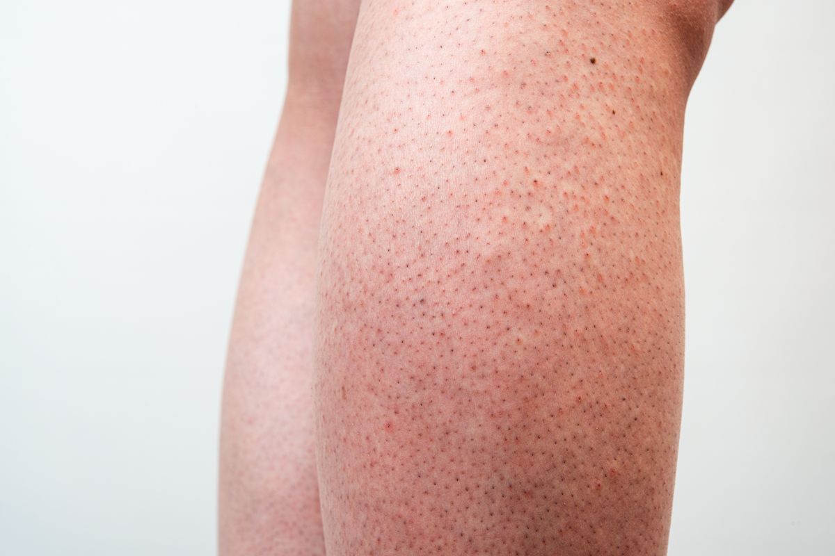 Man’s legs with red dots; looking like a pitted strawberry.