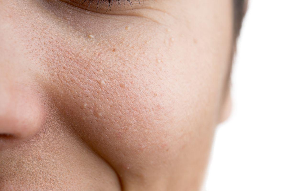 Closeup of facial skin with milia