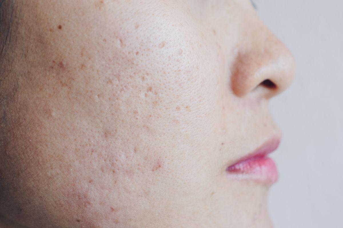 Closeup of woman with acne