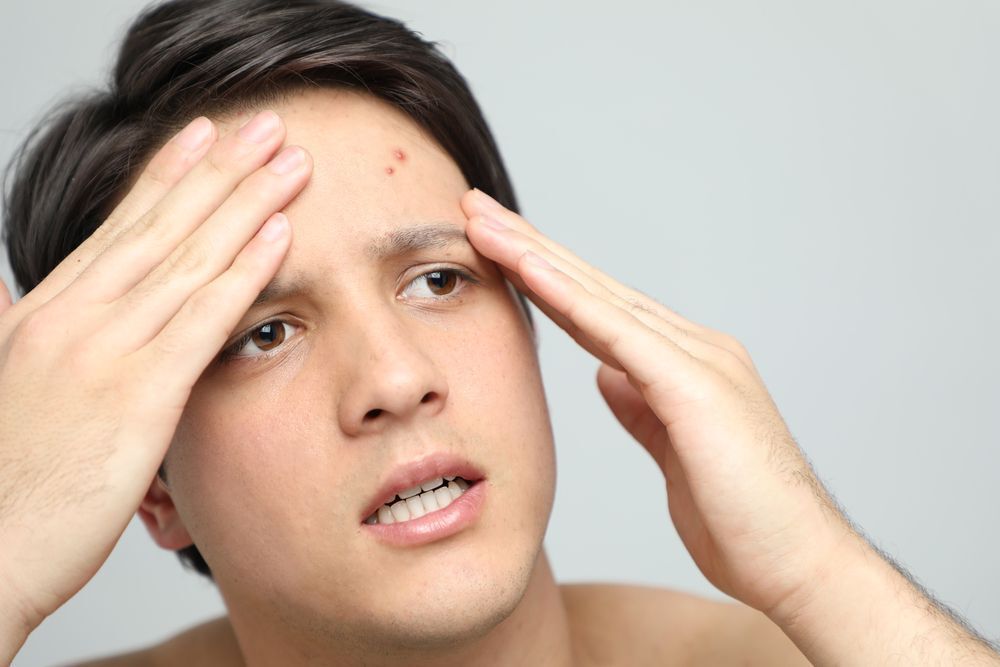 A young man with pimple on his forehead