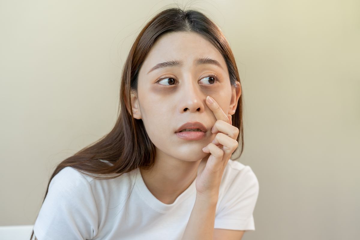 Asian woman with dark undereye circles