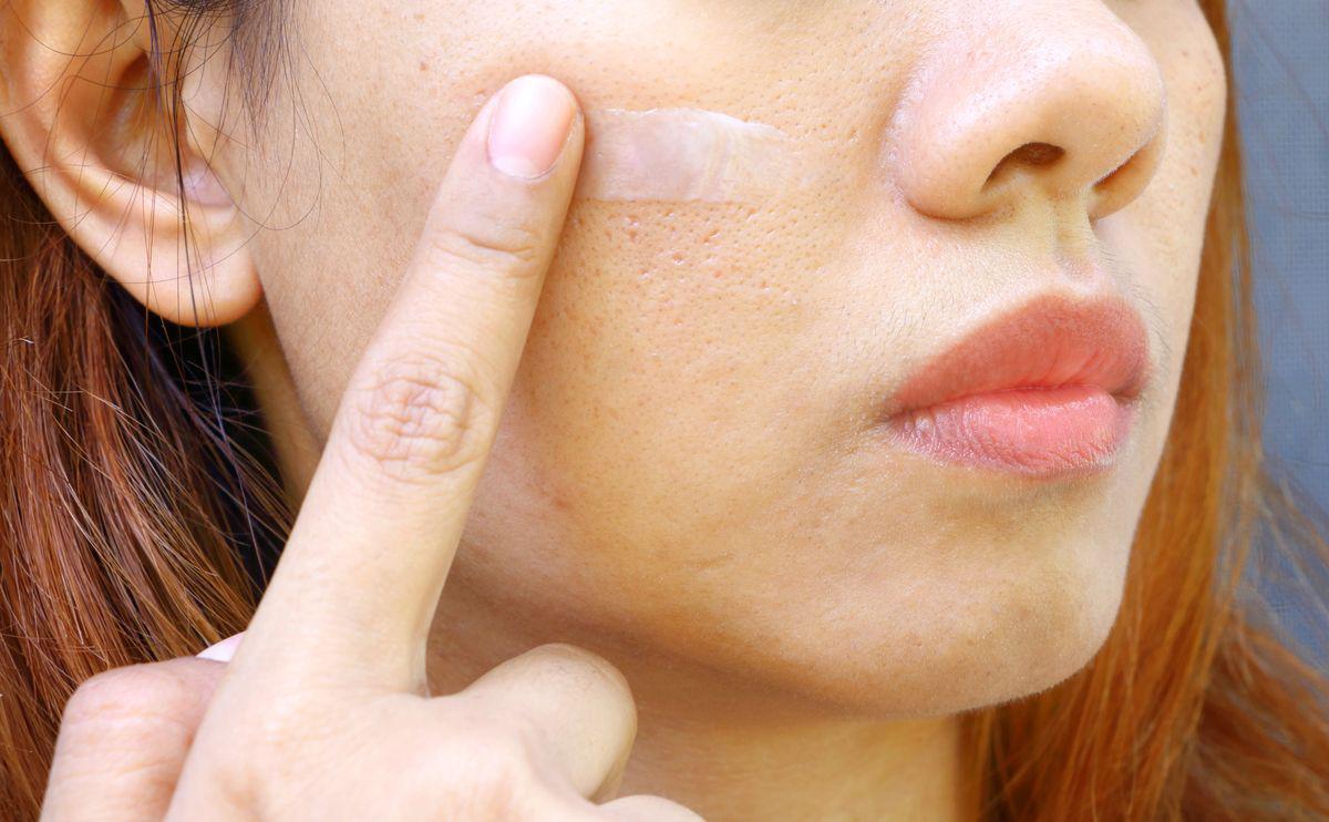 Young woman with large pores applying product 