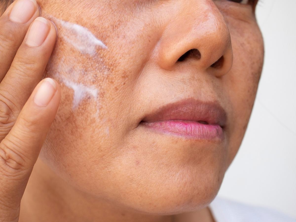 Asian woman applying cream on dark spots