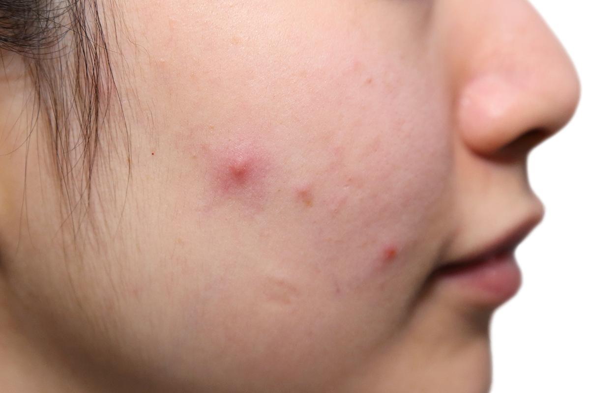 Closeup of a pimple