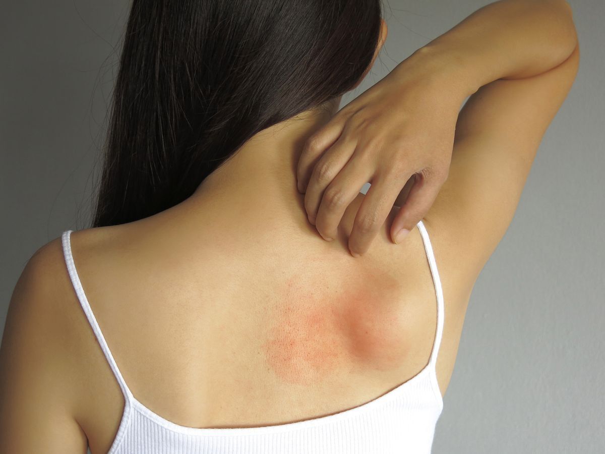 A woman scratching rashes on her back.