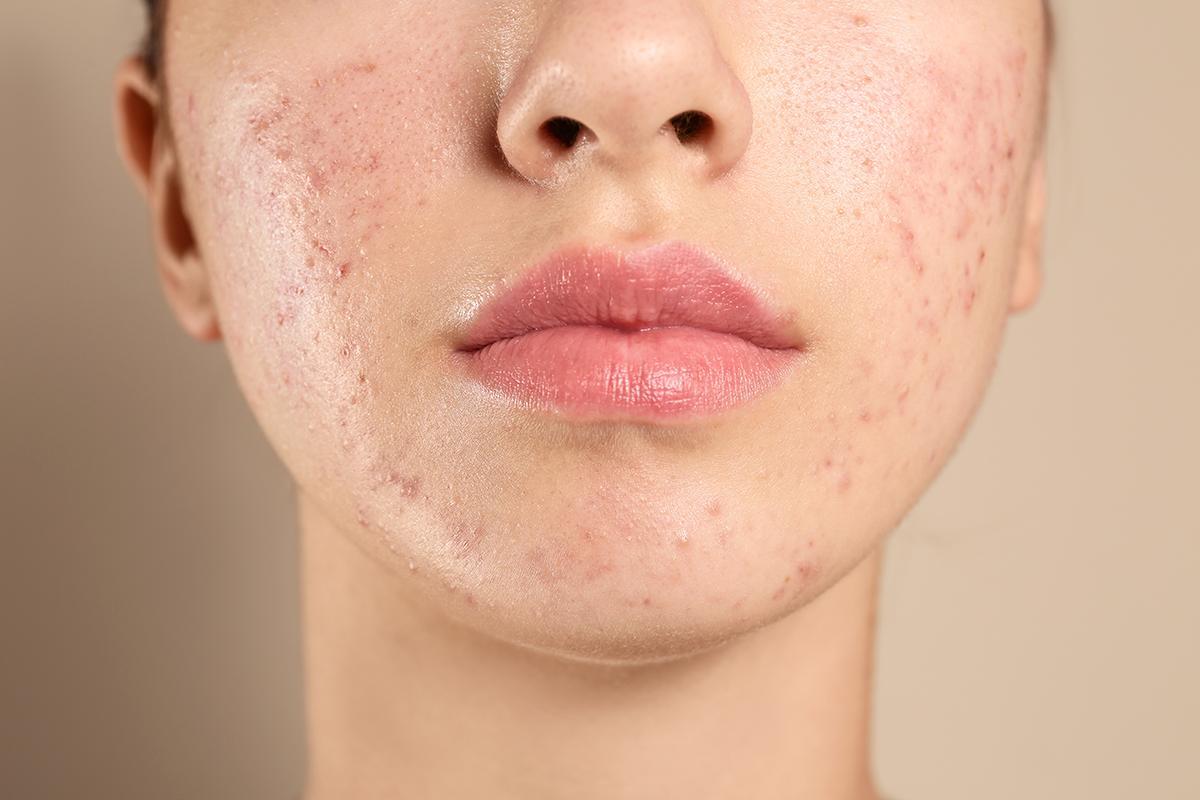 Teenage girl with acne