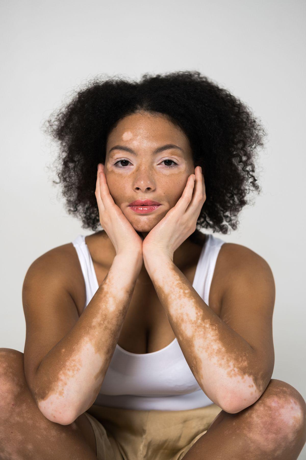 Woman with vitiligo