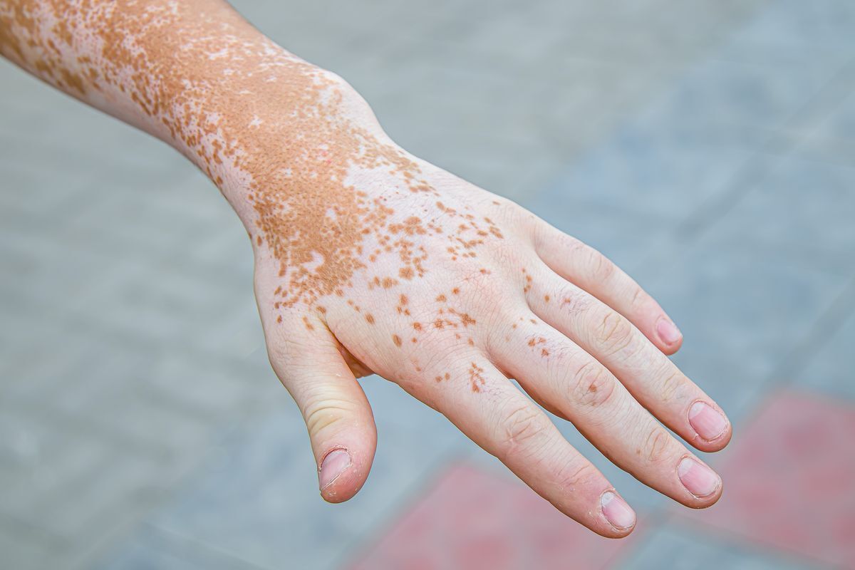 Closeup of a hand with vitiligo