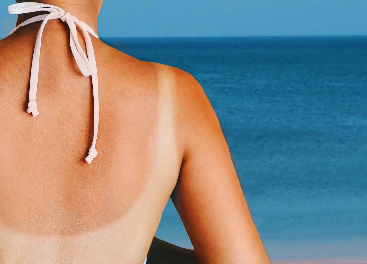 Asian woman with sunburn on back