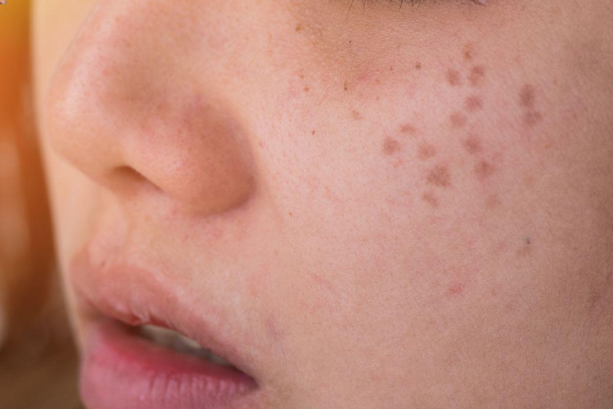 Closeup of freckles on face