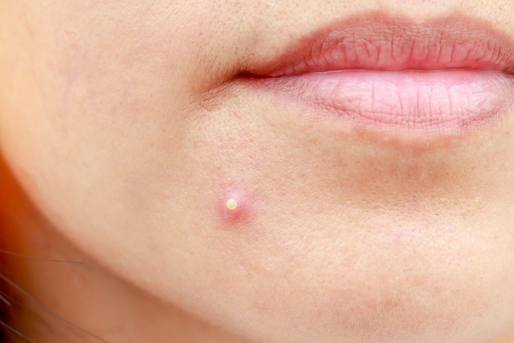 Closeup of a pimple on a woman’s chin.