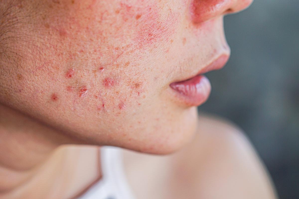 Closeup of a woman’s acne