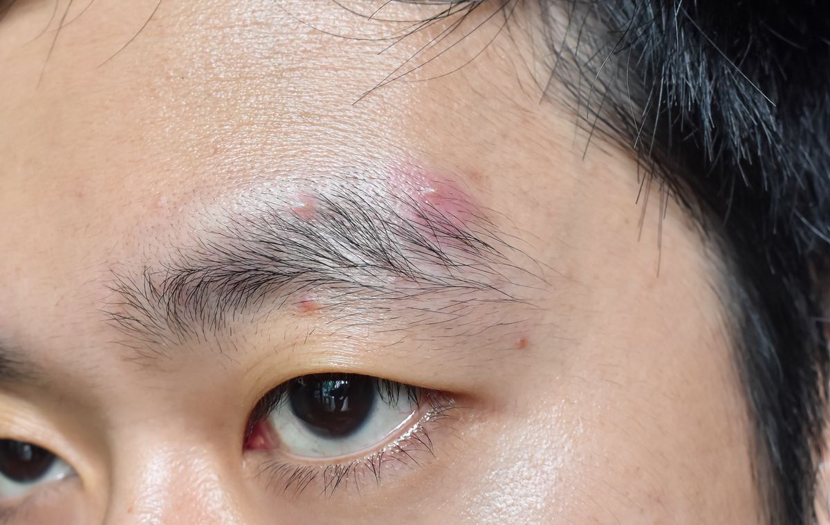 A closeup of a man with a pimple on his eyebrow