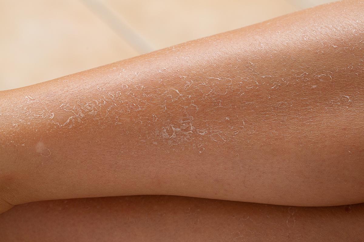Dry skin on legs