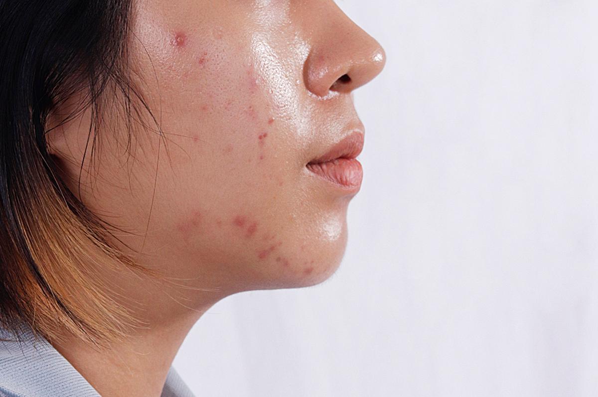 Side view of woman with acne prone skin
