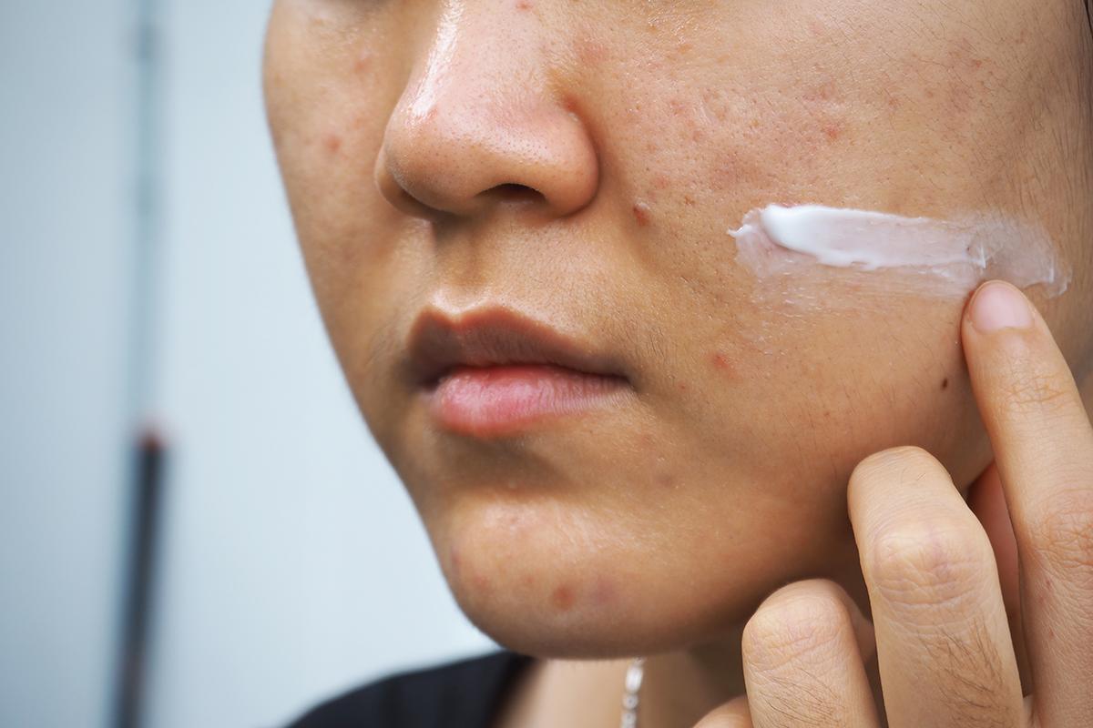 Applying treatment on acne prone skin