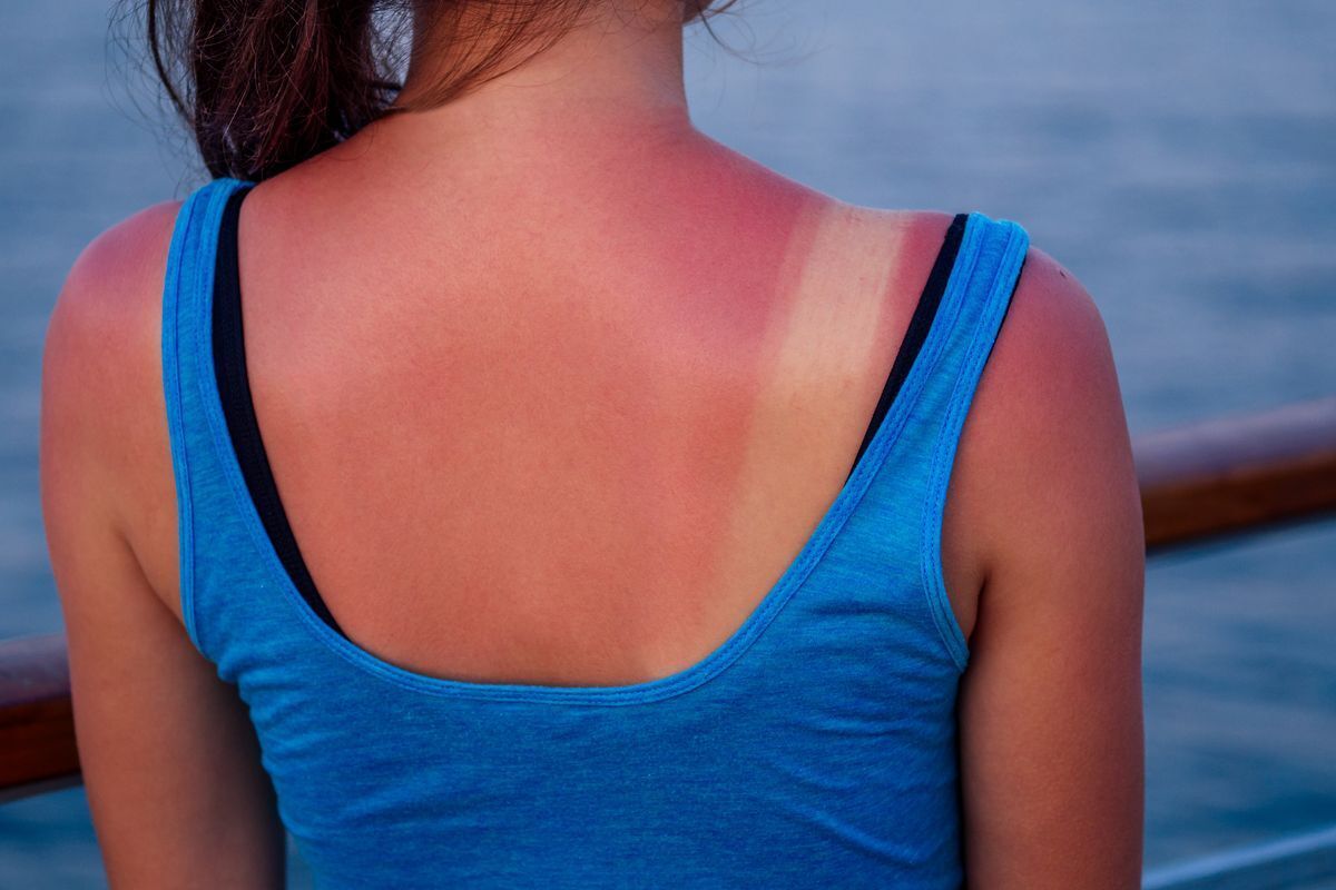 Woman in blue top with sunburnt skin
