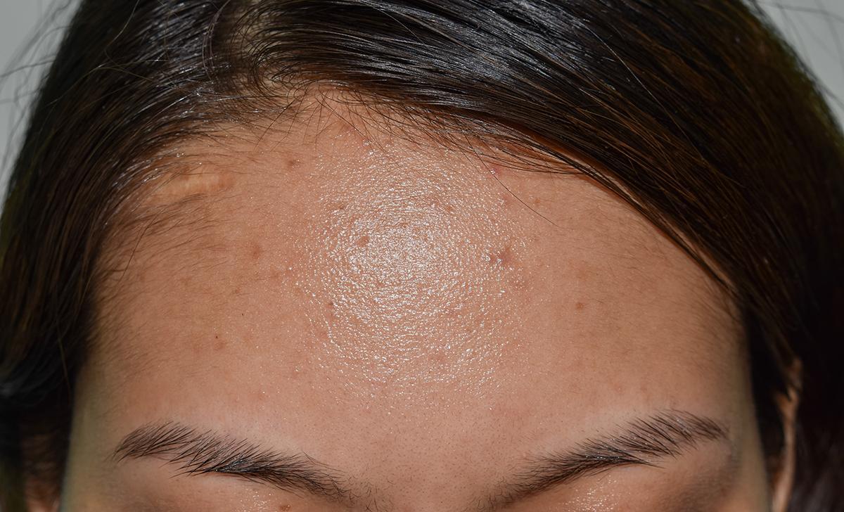 Oily forehead with pimples