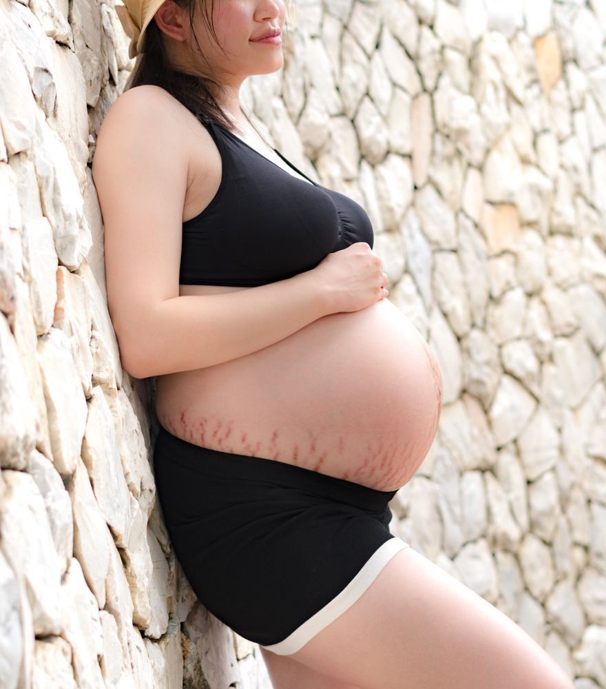 A pregnant woman with stretch marks