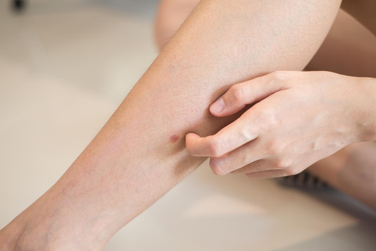 Woman scratching scar on leg 