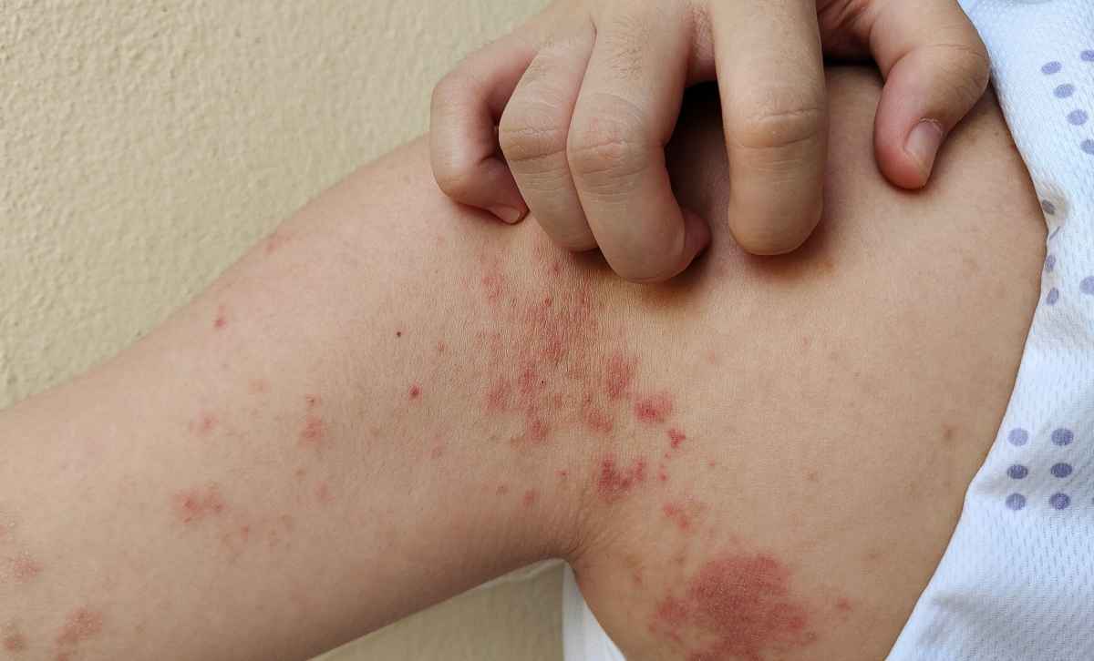 A man scratching rashes on his shoulder.