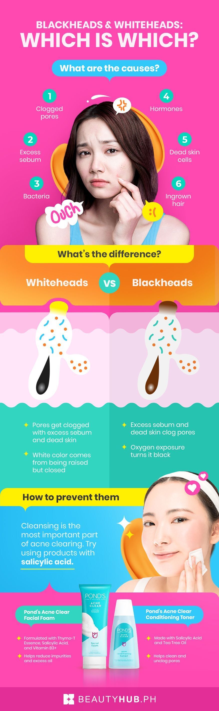 Infographic on blackheads and whiteheads