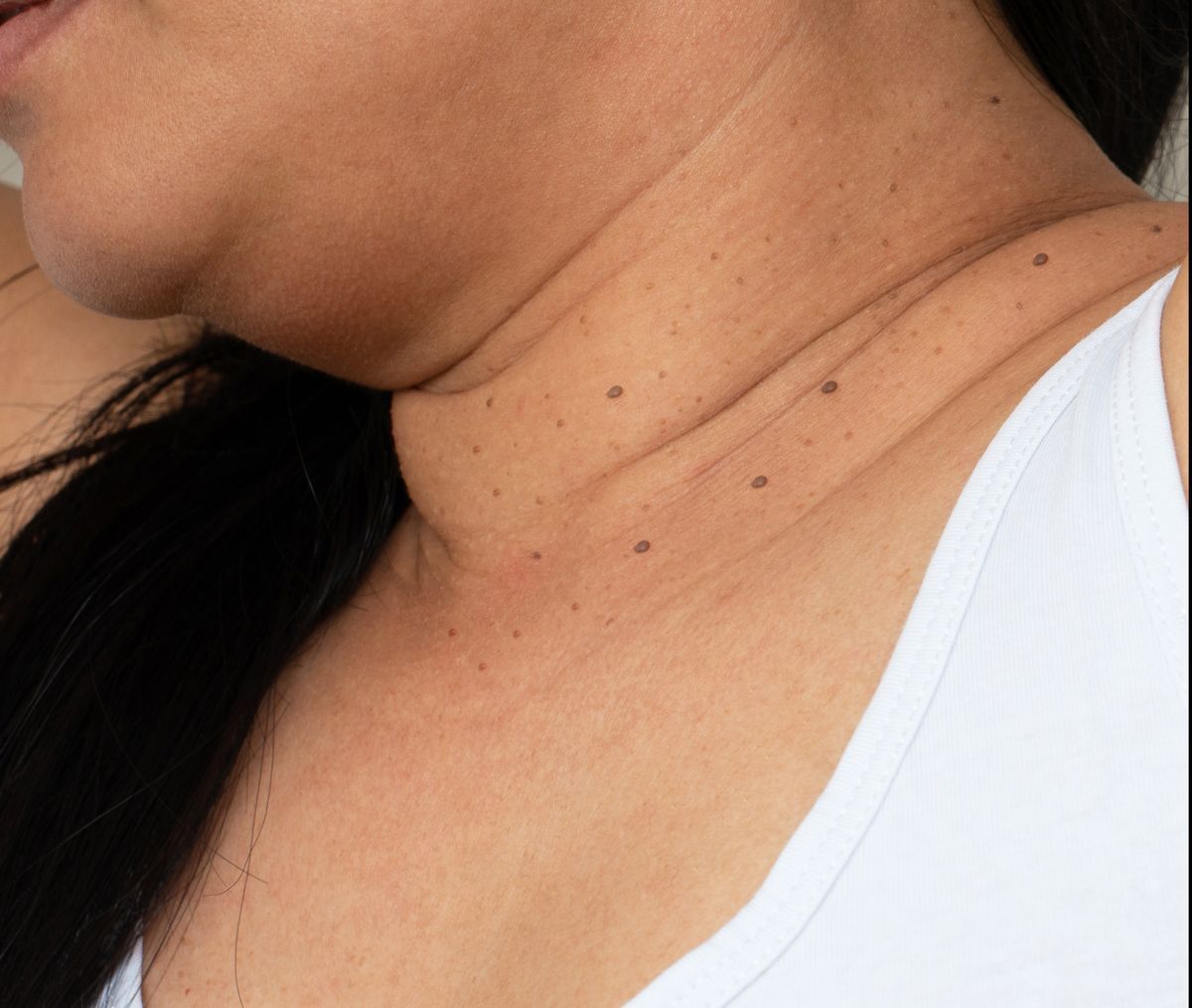 Skin tags on neck