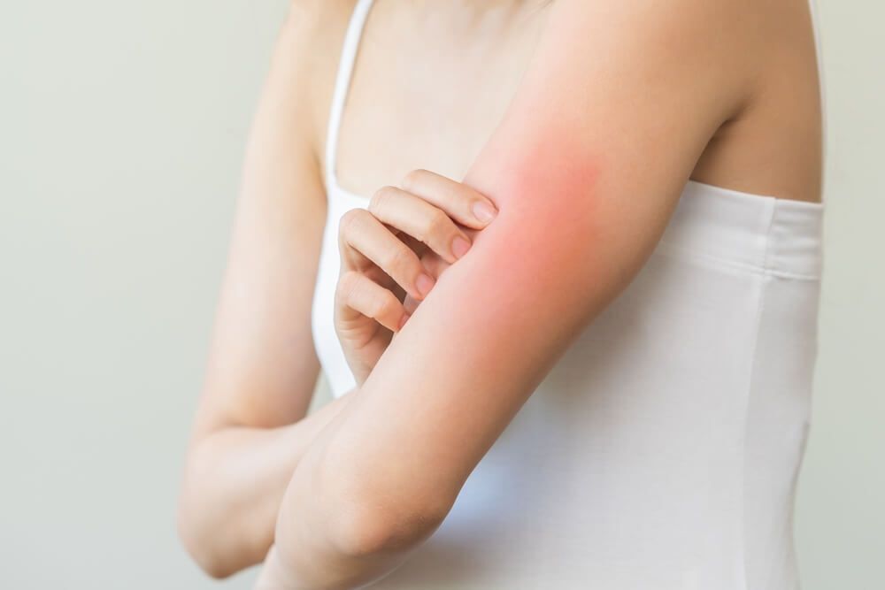 da tay bị bong tróc là do thiếu chất gì viêm da dị ứng chụp nửa người cô gái đang gãi vùng da đang mẩn đỏ ở bắp tay