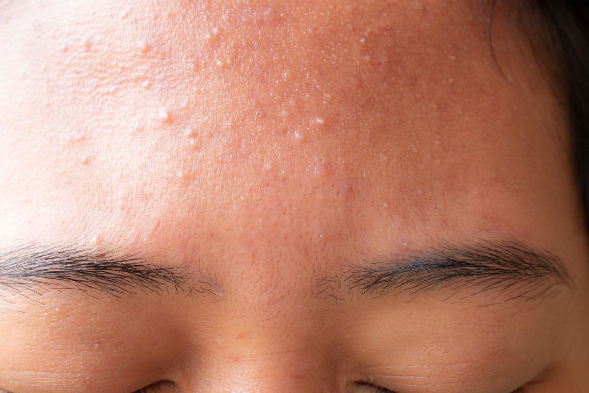 cách trị mụn ẩn trên trán