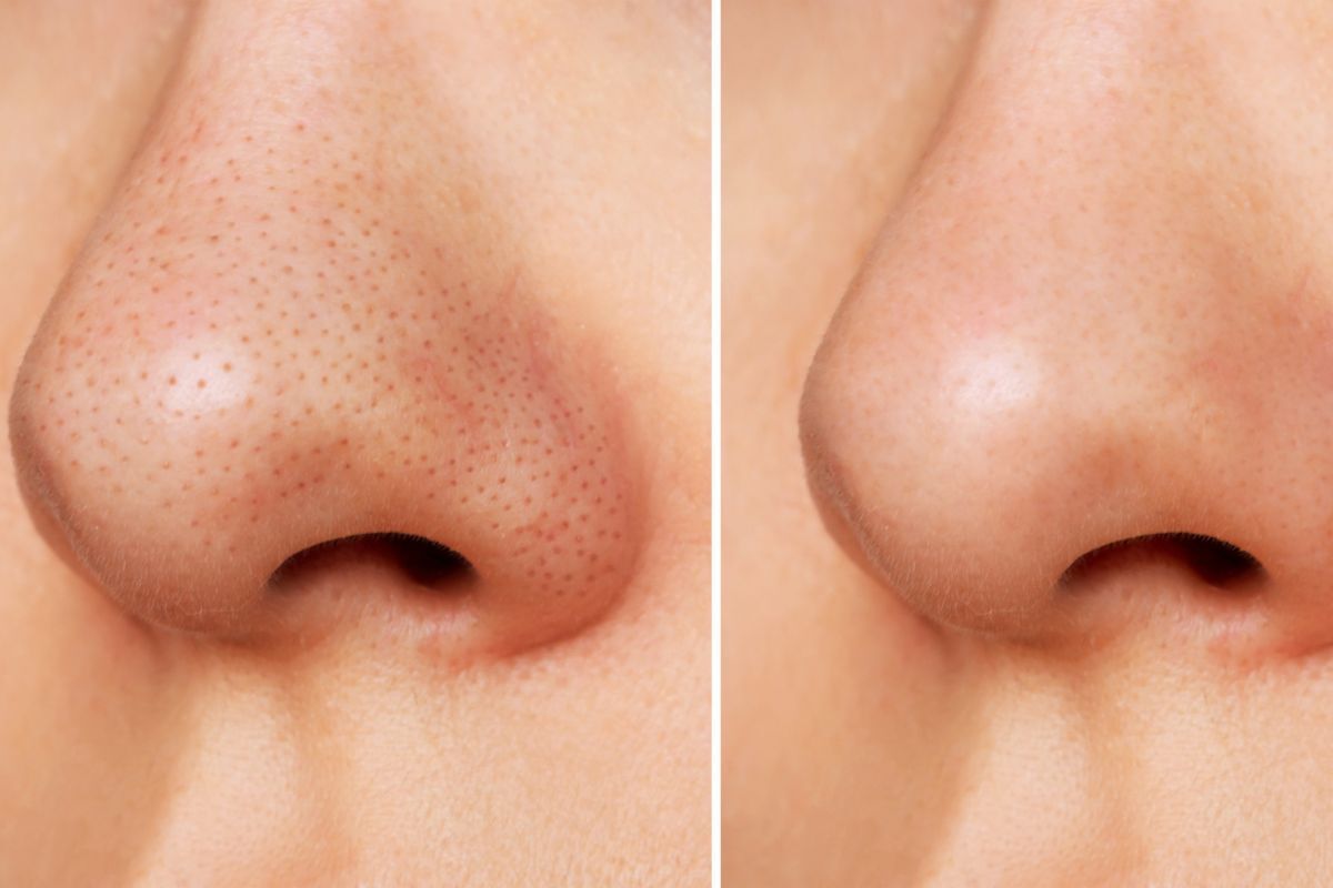 trị mụn đầu đen ở mũi