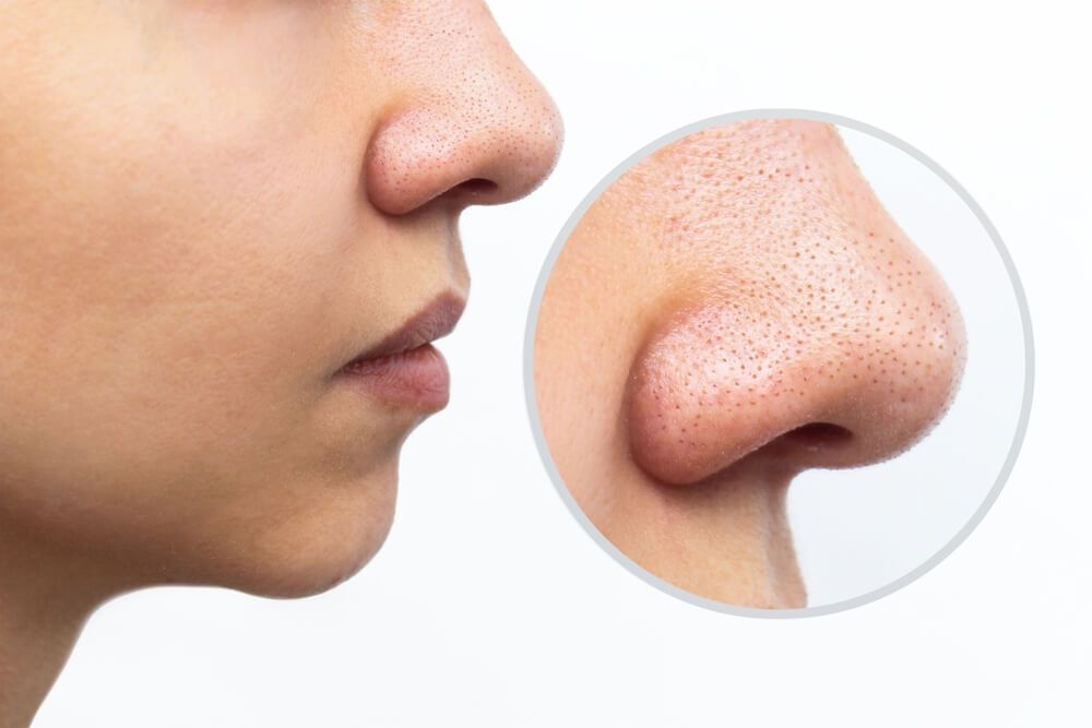 phân biệt các loại mụn mụn đầu đen