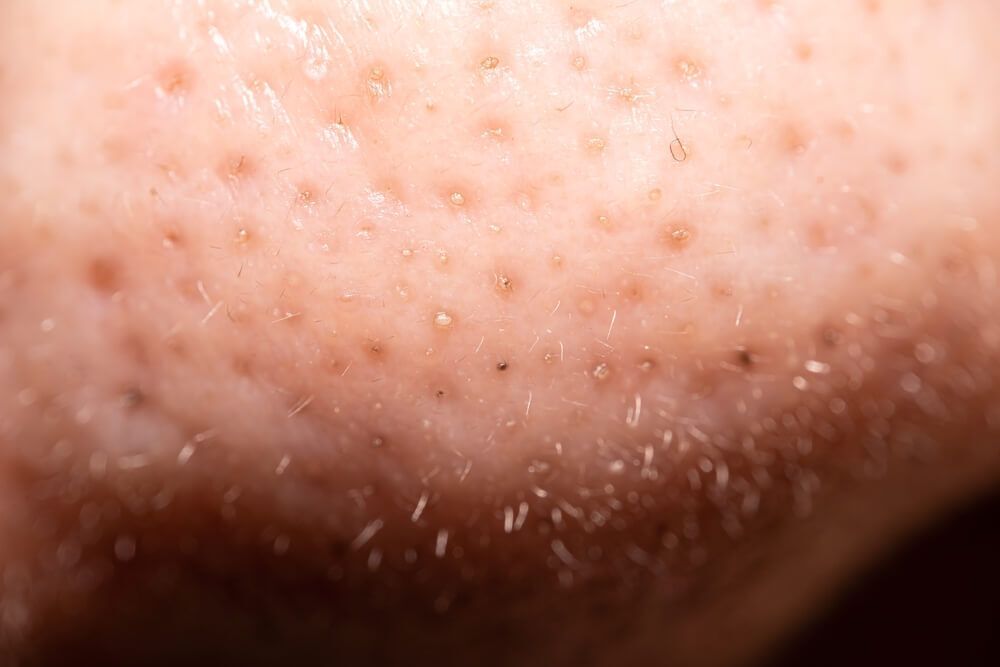 phân biệt các loại mụn mụn đầu trắng