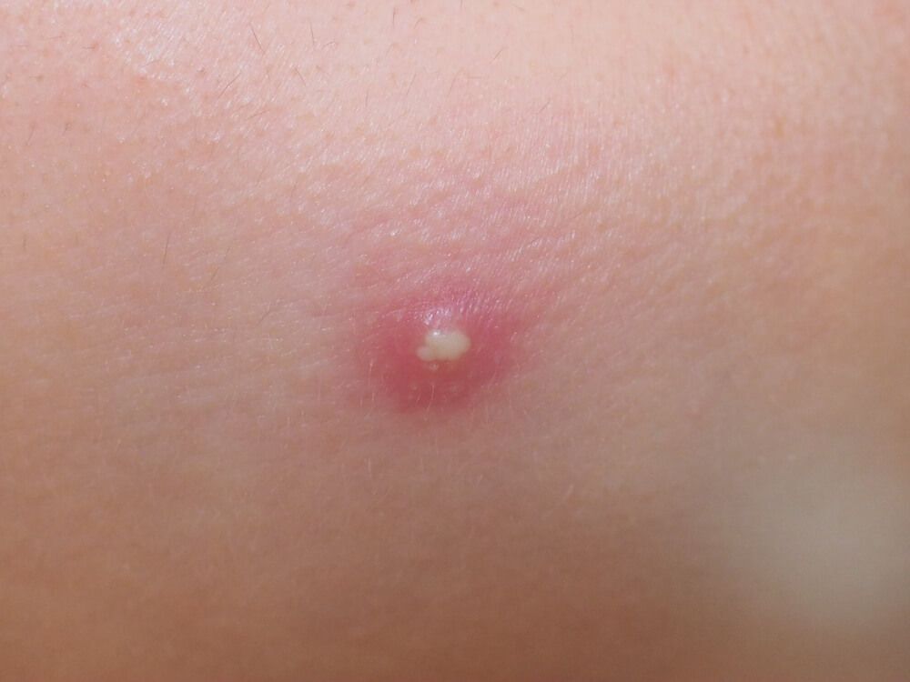 phân biệt các loại mụn mụn mủ