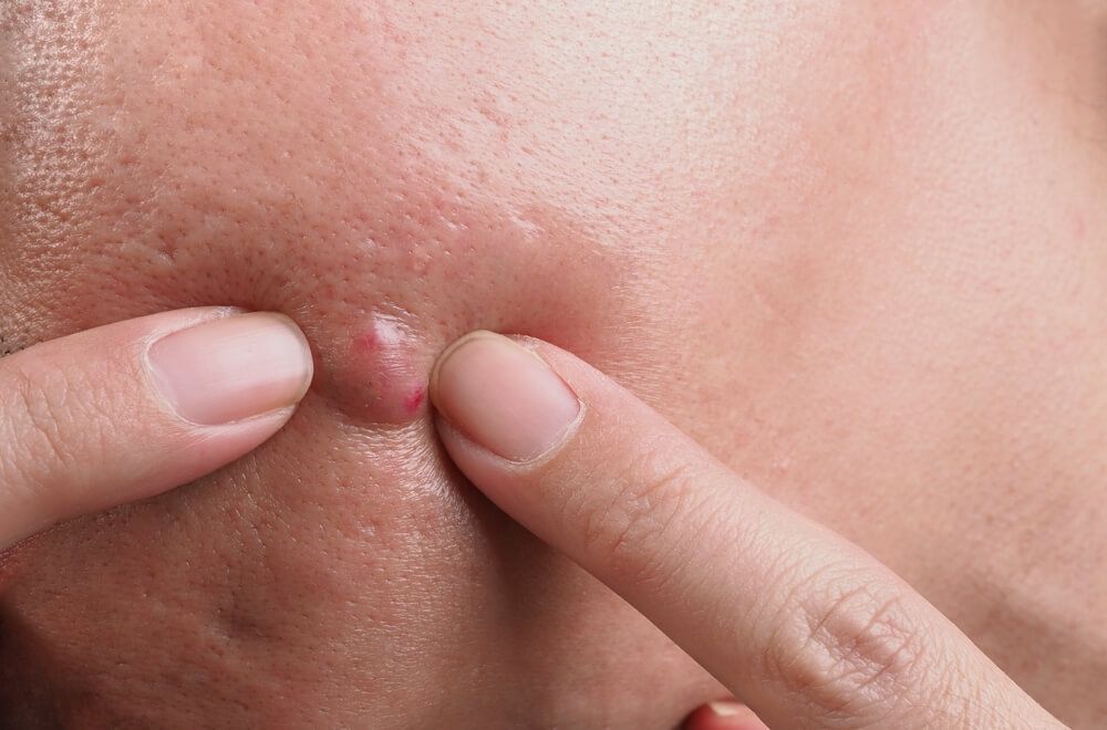 phân biệt các loại mụn mụn nang