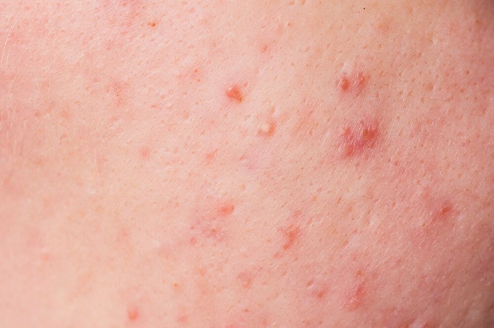 phân biệt các loại mụn mụn trứng cá