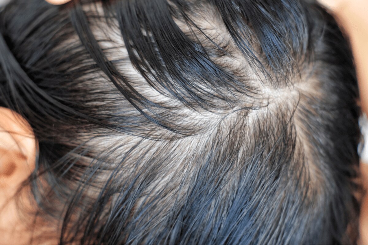 nguyên nhân rụng tóc ở nữ da đầu dầu cận cảnh da đầu dầu khiến tóc bết nhanh