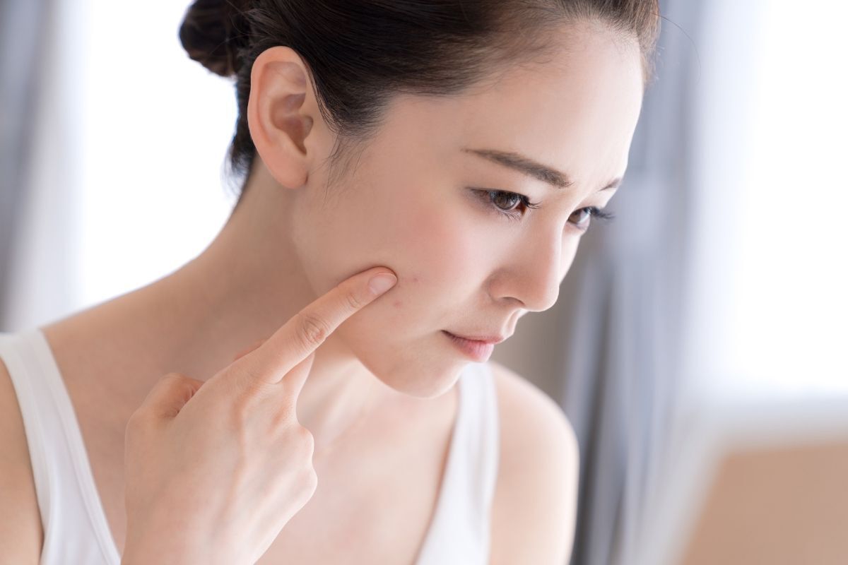 Da dầu hoặc da mụn