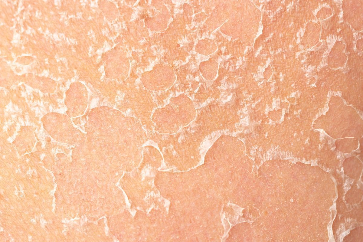  tác dụng phụ của retinol hình chụp cận bề mặt da đang bong tróc