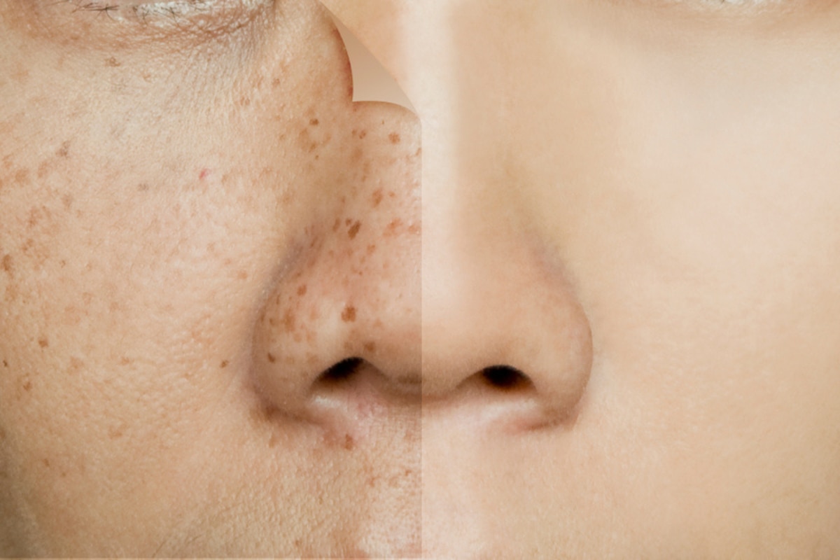 cách trị tàn nhang gương mặt chia làm hai bên với một bên cận cảnh các đốm tàn nhang trên mặt