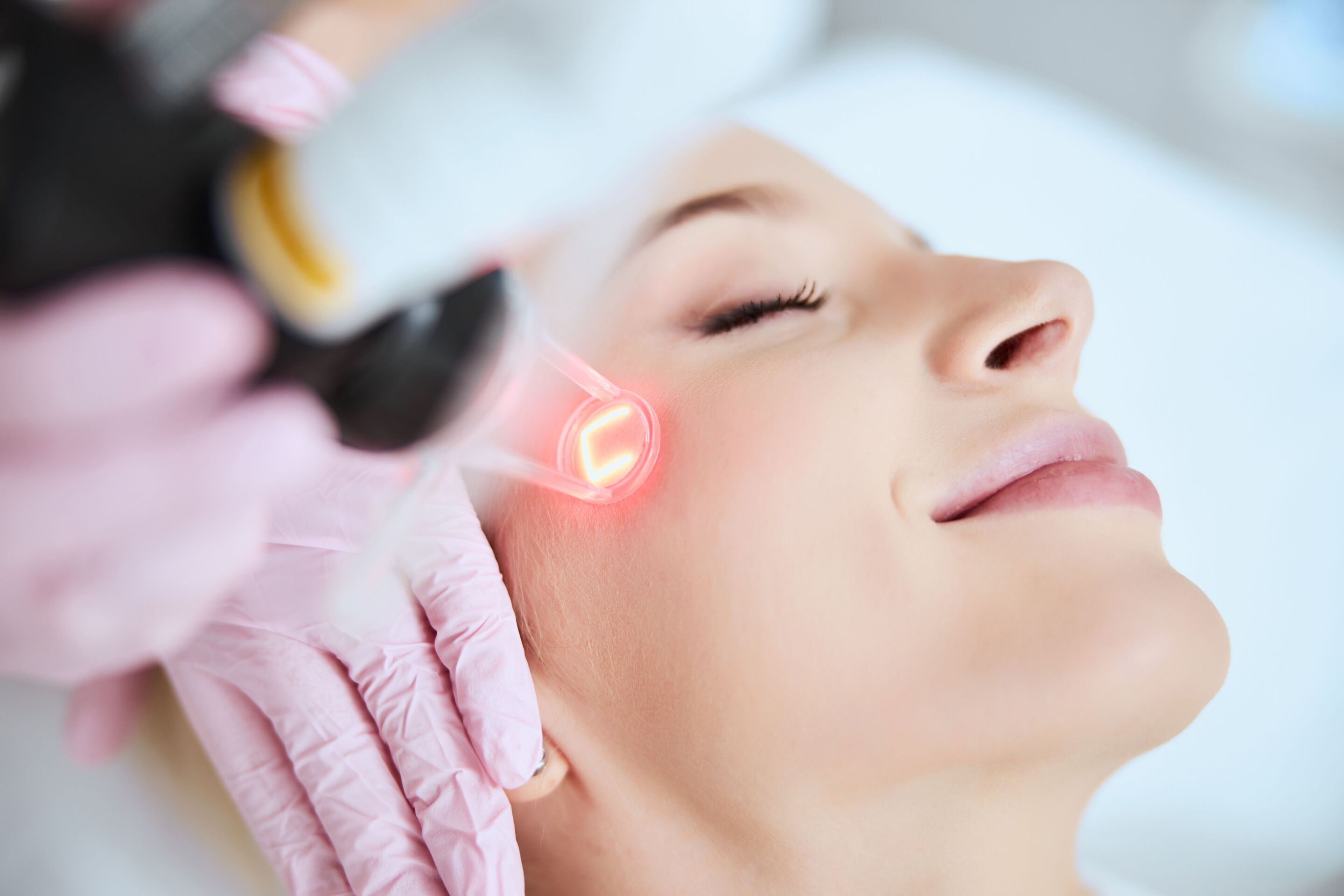 cách trị thâm mụn bằng tia laser