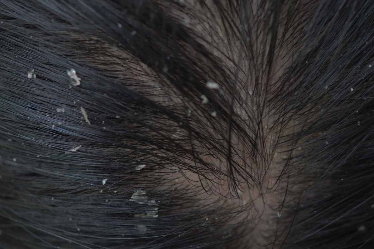 cách trị gàu mảng hình ảnh chụp cận cảnh các mảnh gàu bong ra trên da đầu