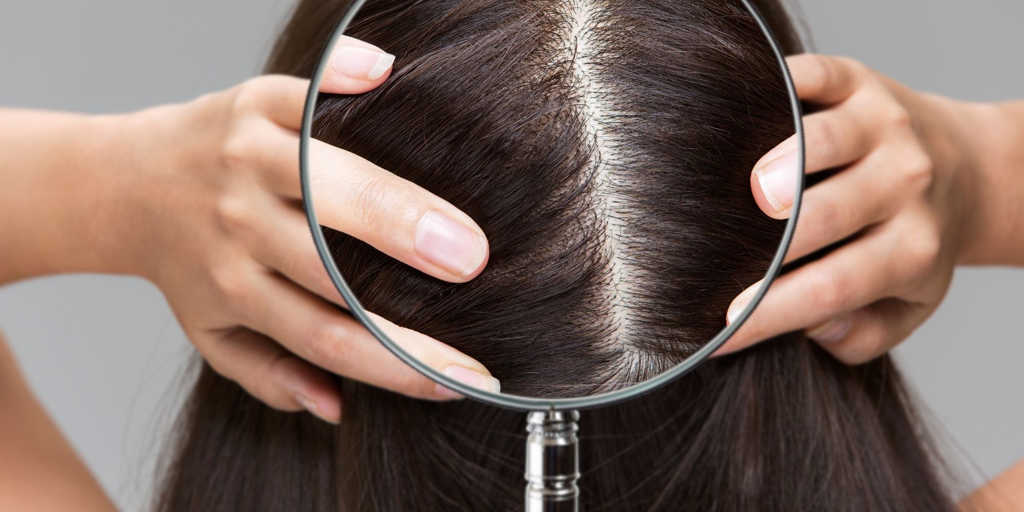 kulit kepala wanita yang sedang terkena masalah ketombe kering