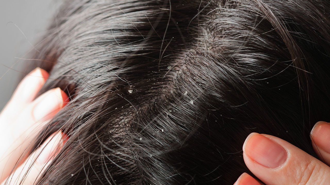 serpihan ketombe di kulit kepala dan rambut