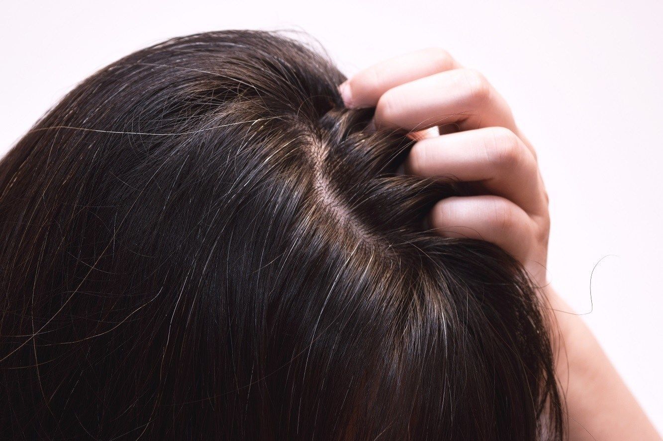 Uban disebabkan banyak faktor