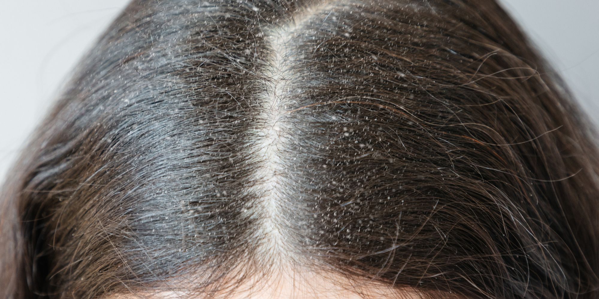 rambut yang dipenuhi dengan ketombe