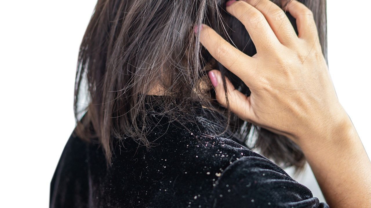 gambar wanita dengan ketombe yang berjatuhan di bahu